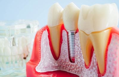 Dental implant frequently asked questions