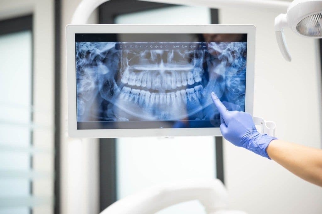 The Importance of Jawbone Density in Oral Surgery Planning